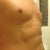 A month after surgery - you can clearly see the small scars here, which I'm hoping will fade completely. I'm thinking of having Laser treatment on them to help them heal and fade.