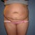 Front view before surgery. The small incisions are from my robotic hysterectomy only 3 weeks before my tt.