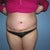 Post op tt 1 week, front view.