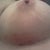 Right breast scar...there is still some marker residue...scar is small