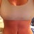 6 months after surgery