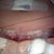 incision