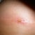 Incision looks much better Day 19