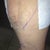 Left leg 3 days post op