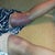 Bruising on the back of my thighs. Eww I hate this pic! But part of the problem was that I was walking TOO much! So take it easy ladies, no more than 20 minutes at a time, then lay down and give your legs a break!