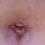 Close up of infection. Antibiotics  cleared it up pretty fast though! It was looking pretty nasty LOL
