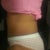 1 month post op...