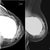 NOTE- this is a mammogram of SOMEONE ELSE! Not me! Just to show what CC might look like underneath. I dont know if this is subglandular or subpectoral