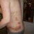 This side is the worse- day 4 post op
