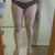 Inner thighs again day 1 post op