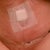 2 days Post Op - after getting stitches cut due to pinched nerve.. so a little swollen but pain is only from pinch nerve nothing else.