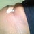 Dog ear revision and the scar