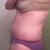 Wk 12 PM Swelling-Looks like Pre op-Even lipo areas swell