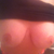 3/2012 keep in mind i had a full lift up and around the nipple CAN YOU SEE THE SCARS! NOPE best doctor ever
