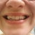my 'normal' smile, you can't see the bottom pontics or attachments, thankfully.