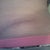 5 weeks left side. This is the side that had a big bump on it thought it was going to be a dog ear. I think between creams and silicon strips it has gone flat.