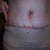 one last one...I pointed to where incision ends on each side.  I am pretty narrow from hipbone to hipbone and was thinking it would go further out on sides.  Know it will only get better!