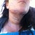 Day 1 post of lip of neck and chin ,,, I never really did bruise much here but I do have stitches behind ears and under chin ,, the purple is marker ,, didnt hurt just like if you had a bruise on your face but I think thats cause my doc out a lot of numbing med cause my chin and neck is still numb when it swells