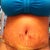day 2 post op tummy mad as hell about the surgery thats y its swollen and stretch marks look really raised they do calm ladies have no fear it gets better