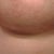2 mths PO - Righty