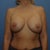 after, left breast much larger as well