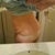 Tummy tuck pre-op