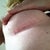 Scares after 3 weeks , healing really well