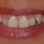 My teeth as of today 01.11.2010