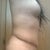 3 wks higher scar on right side with bulge