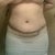 3 wks, here you can see the unevenness of the scar and fat distribution---will probably need a revision :(