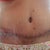 11 days post op, straight on. The skin pucker looks pretty awful! Will that go away?