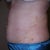 2 days post-surgery
