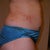 2 days post-surgery. The bruises are where the garment was bunched up.