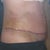 14 days PO (see the distention in lower ab)