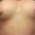Before pic as you can see im very asymmetrical and the smaller breast is also higher :( cant wait to fix them!!!