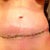3 weeks PO still swollen