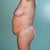 Before mommy makeover, side