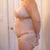 Five days post op, mommy makeover, side