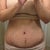 Doctor said that scar will turn bright red before it fades . my most stubborn part is lower stomach when it comes to swelling , inscition  feels like a dam.