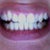 Another before picture.  No Invisalign, no extraction.