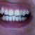 This was after I had my tooth extracted and after one tray of Invisalign.