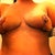 8 days post-op