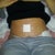 4 days post op