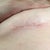 4 wk scar