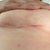 4 wk scar