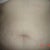 2days before surgery, close up of my tummy