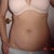 2days before surgery, front view