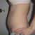 2days before surgery, side view