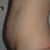 2days before surgery, side view