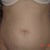 2days before surgery, front view